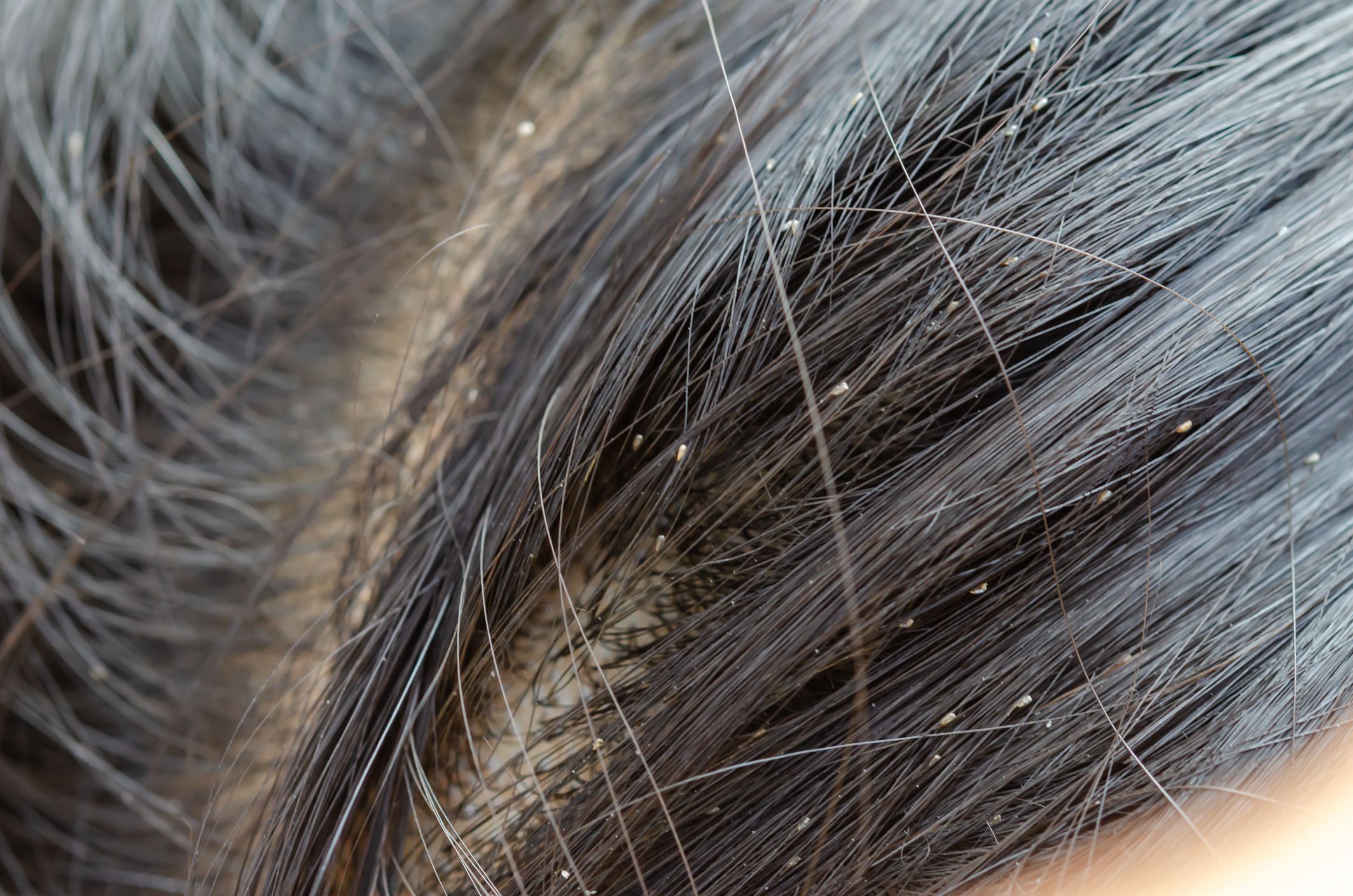 HEAD LICE Shri Vishwadatta Ayurved